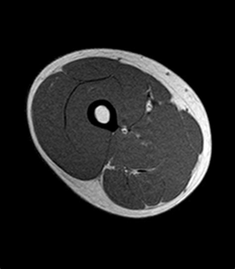 Upper Thigh Muscles Ct Anatomy - Msk Ultrasound Regional Medical Imaging : Study ct anatomy ...