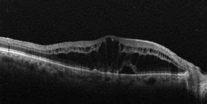 BRVO Before - The Retina and Macula Centre