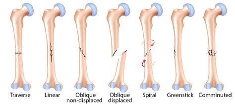 Different types of bone fracture - Aslosweet