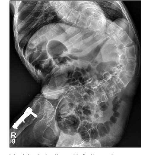 Figure 1 from Endoscopic Management for Colocutaneous Fistula as a Complication of Percutaneous ...