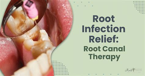 Root Infection Relief: Root Canal Therapy