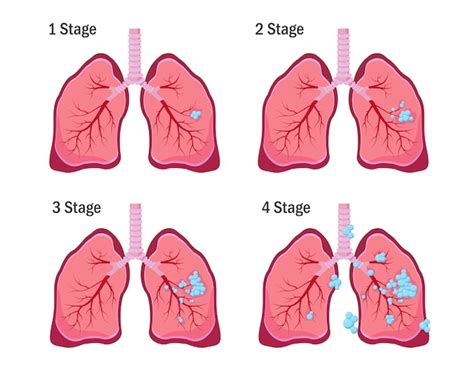 Premium Vector | Lung cancer concept. four stages of lung cancer disease.