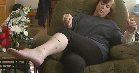 Dog Attack Victim Urges Owners To Come Forward - CBS Colorado