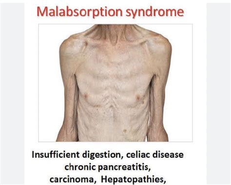 Malabsorption Syndrome: Causes, Treatment & Prevention - Dr AvinashTank, is a super-specialist ...