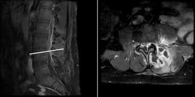 Spinal Epidural Abscess: Background, Pathophysiology, Epidemiology