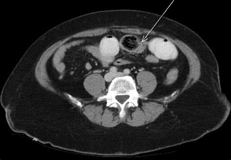 Laparoscopic extraction of phytobezoar. One arrow points to the... | Download Scientific Diagram