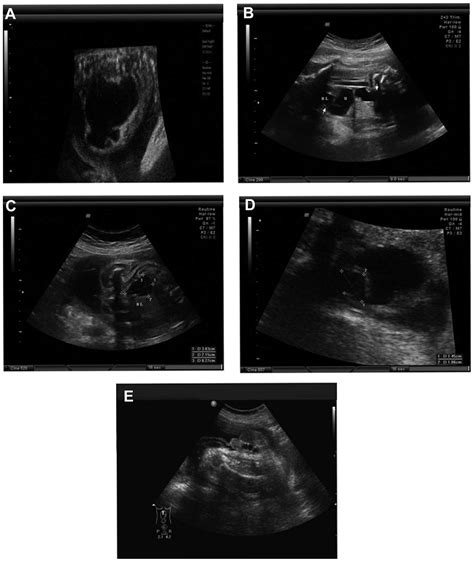 Hydronephrosis In Fetus And Down Syndrome - Pregnant Center Informations