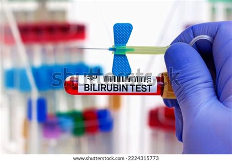 Blood Sample Patient Bilirubin Test Laboratory Stock Photo 2224315773 | Shutterstock