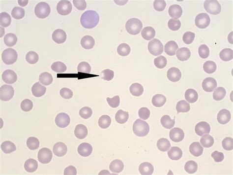 Bite (Keratocyte) & Blister (Helmet) Cells – A Laboratory Guide to ...