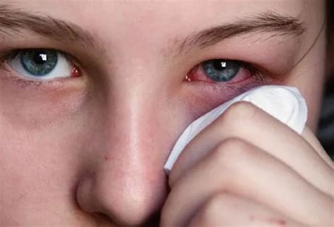 Pink Eye (Conjunctivitis) Causes, Types, Symptoms, Treatment