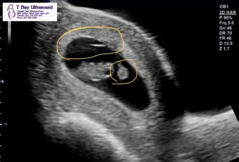 8 Week Ultrasound Hidden Twins