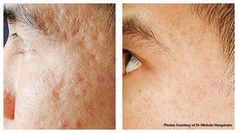 Acne scars and pock mark treatment by laser skin resurfacing Source ...