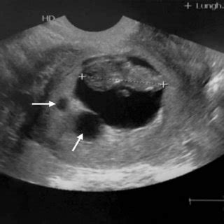 Ultrasound findings of intrauterine pregnancy with a live embryo and ...