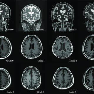 Brain atrophy in structural MRI using visual rating scales. (A) Medial... | Download Scientific ...