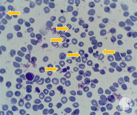 presentation of many large platelets in peripheral blood 4