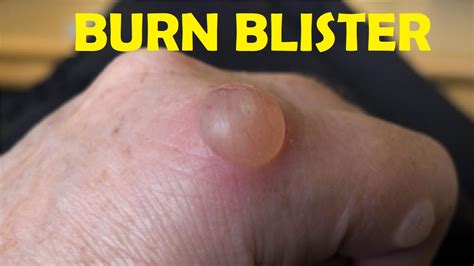 how to treat a burn blister on finger - YouTube