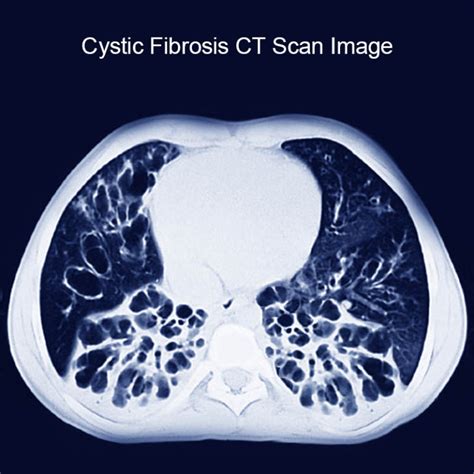 Cystic Fibrosis Causes, Signs, Symptoms and Treatment