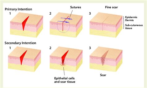 Difference in wound healing between primary and secondary intention closure | Download ...