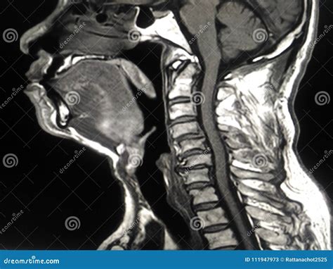 MRI Cervical spine stock image. Image of anatomy, bone - 111947973