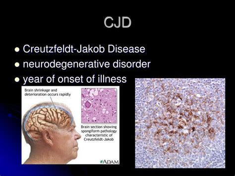 PPT - CJD and Kuru: Prion Viruses PowerPoint Presentation - ID:3622715