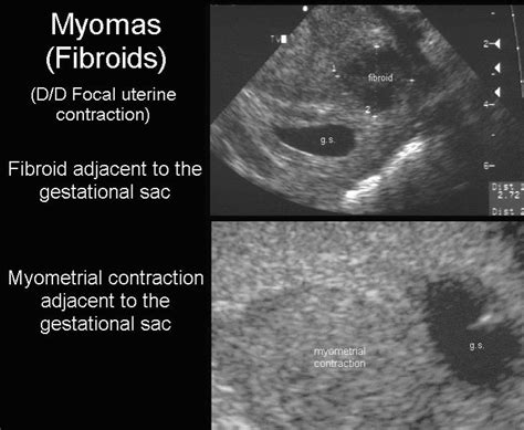 Uterus Fibroid Ultrasound