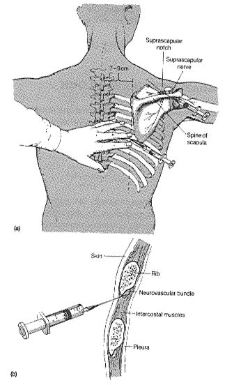 Intercostobrachial Nerve Distribution