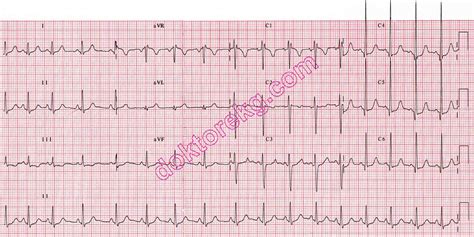 normal pediatric ecg samples - dr. mahmut gokdemir - elektrokardiyografi (ekg ...