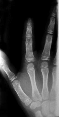 MCP Dislocations - Hand - Orthobullets