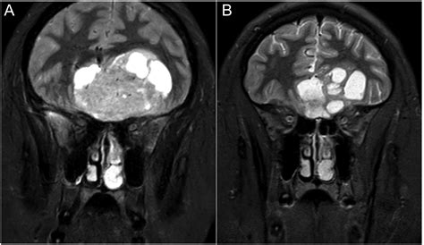 Foster Kennedy syndrome secondary to a giant prolactinoma with a remarkable response to ...