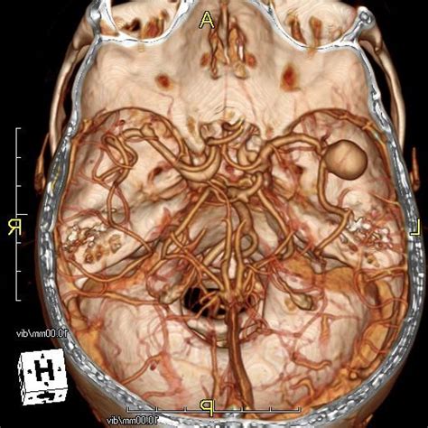 Chụp mạch máu não bằng CT hoặc MRI - Y học cộng đồng