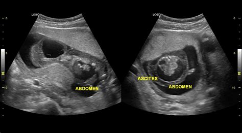 Ultrasound 101(Hydrops fetalis) : r/Radiology