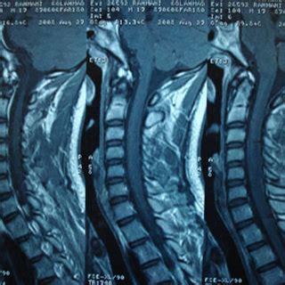 (PDF) Cervical Transverse Myelitis After Chickenpox in An ...