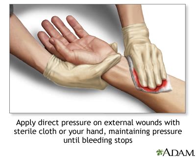 Bleeding | UF Health, University of Florida Health