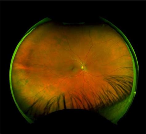 SPOTLIGHT ON Atrophic Retinal Holes - Ophthalmology Education