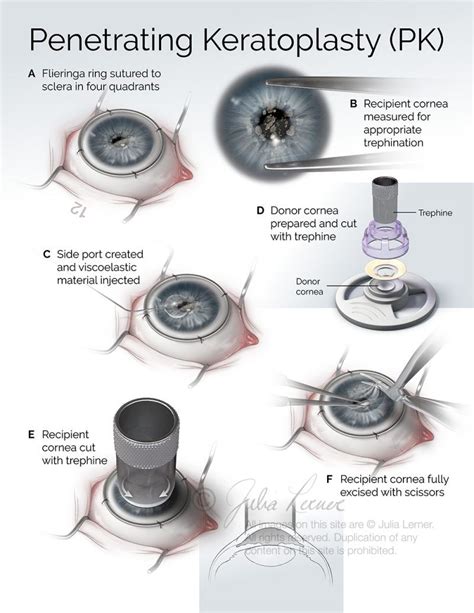 A Trephine Is Used in Which Ophthalmologic Procedure - ImmanuelkruwJuarez