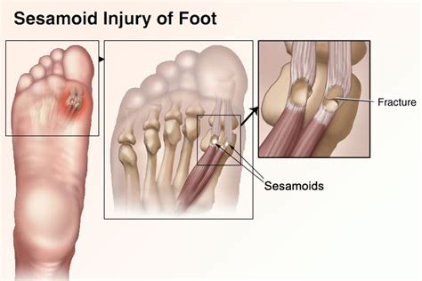 Pain Under The Big Toe | Melbourne Podiatry Clinic