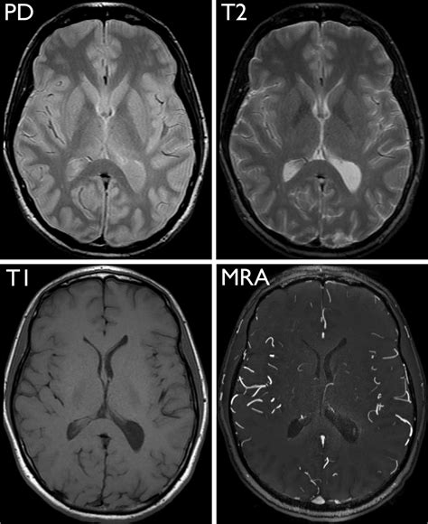 Exploring the Brain: How Are Brain Images Made with MRI? | UCSF Radiology