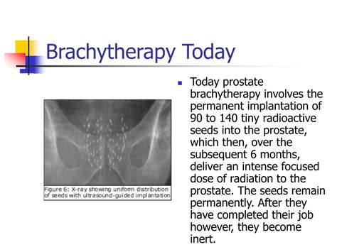 PPT - The Prostate Gland, Prostate Cancer, & Brachytherapy PowerPoint ...