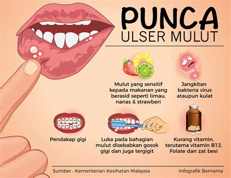 Sinar Harian - Punca-punca ulser mulut #infografik