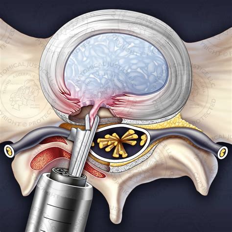 L5-S1 endoscopic posterolateral discectomy, hemilaminectomy, and foraminotomy (shown from a ...