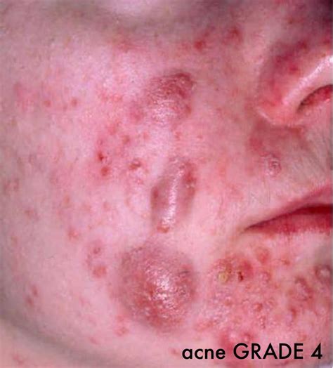 Acne Grade Four