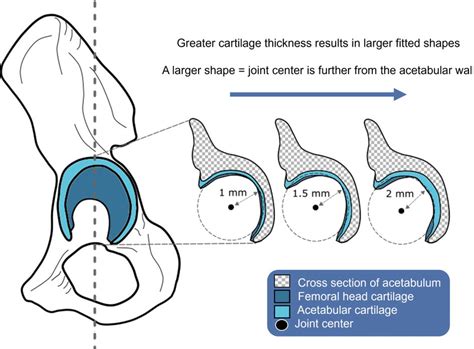 Hypothetical diagram explaining how cartilage thickness in the hip... | Download Scientific Diagram