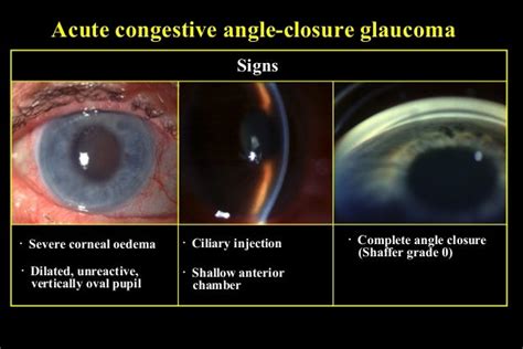 29 primary angle closure glaucoma