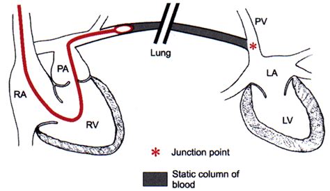 pulmonary capillary wedge pressure (swan ganz catheter) Ccrn Review ...