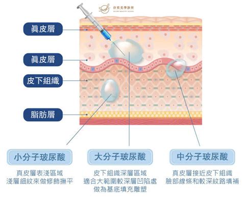 玻尿酸注射,玻尿酸淚溝,玻尿酸法令紋 | 存奕美學診所,桃園醫美診所