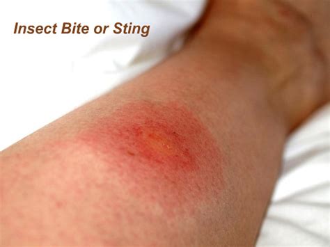 Insect Bites And Stings - Health And Medical Information