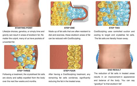 SculpSure/CoolSculpting - Fremont, CA: New Image Medical Spa