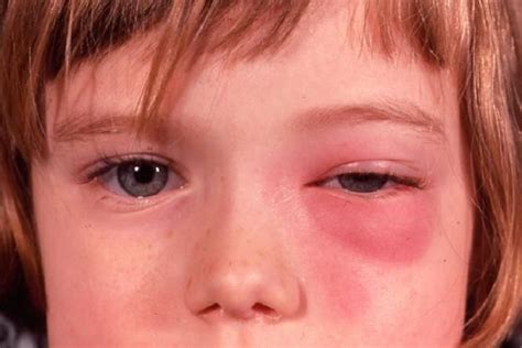 ORBITAL CELLULITIS | Eye care, Sinusitis, Acute sinusitis