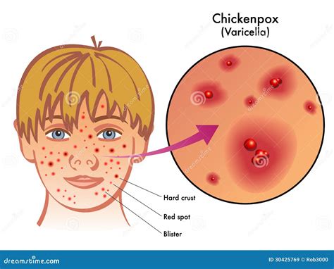 Chickenpox stock vector. Illustration of headache, exanthematous - 30425769