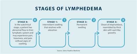 Lymphedema Guide: What Is Lymphedema? - Tactile Medical